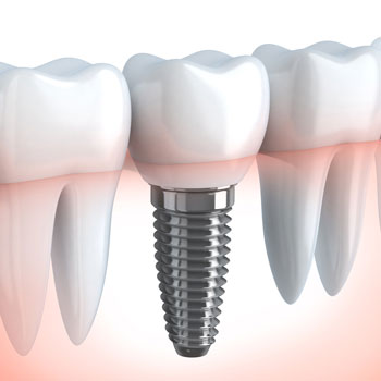 implant dentaire