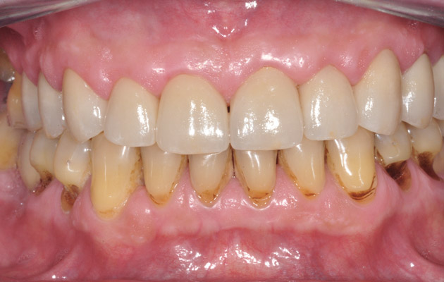 dents jaunes et tâchées après traitement