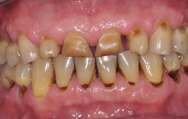 dents jaunes tâchées