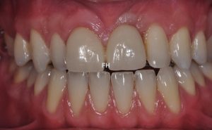 implant - dents provisoires