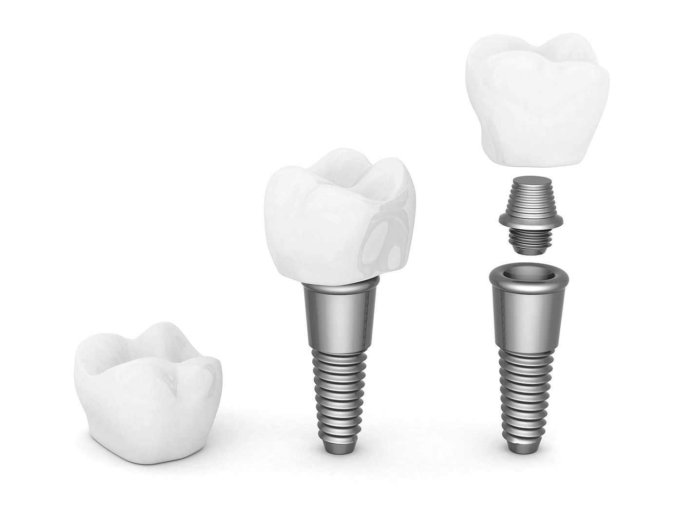 prothèse sur implant