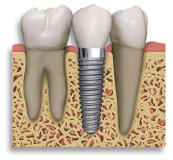 prothèse sur implant dentaire