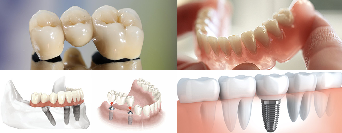 Différents Types de Prothèses Dentaires