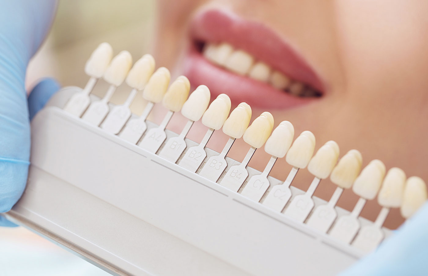 Blanchiment dentaire : techniques, gouttières... pour des dents blanches !